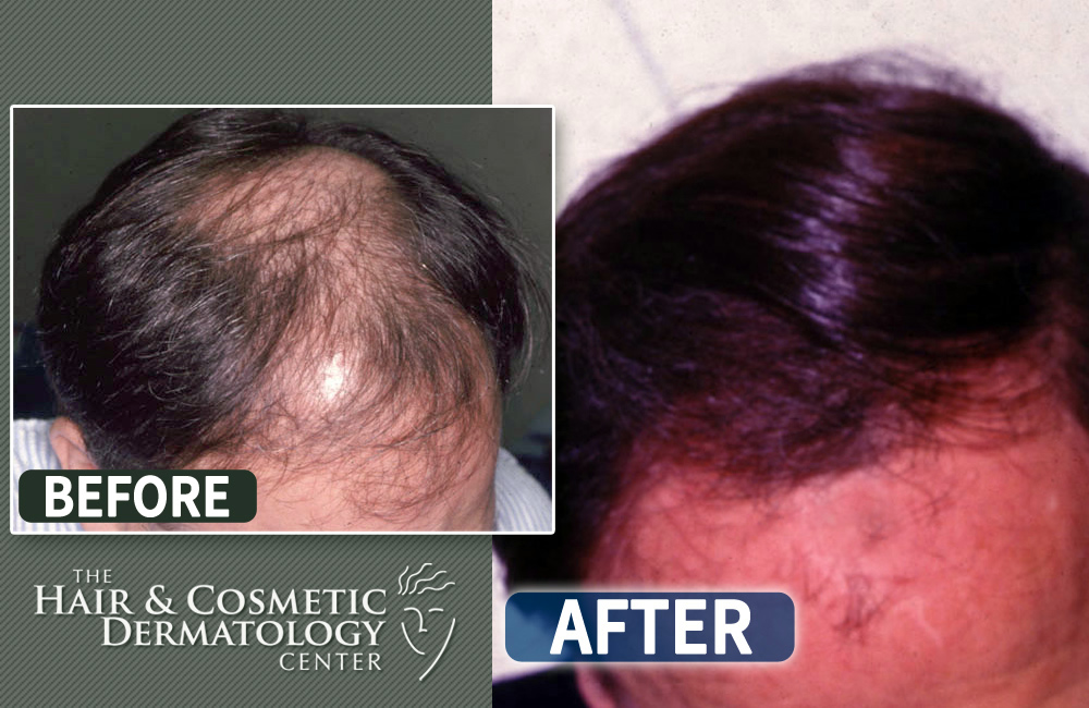 beforeafter2 The Hair & Cosmetic Dermatology Center